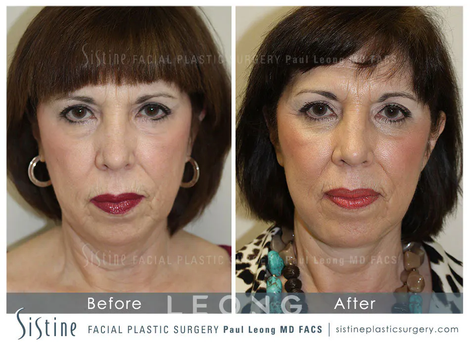 Blepharoplasty Before and After | Leong Facial Plastic Surgery