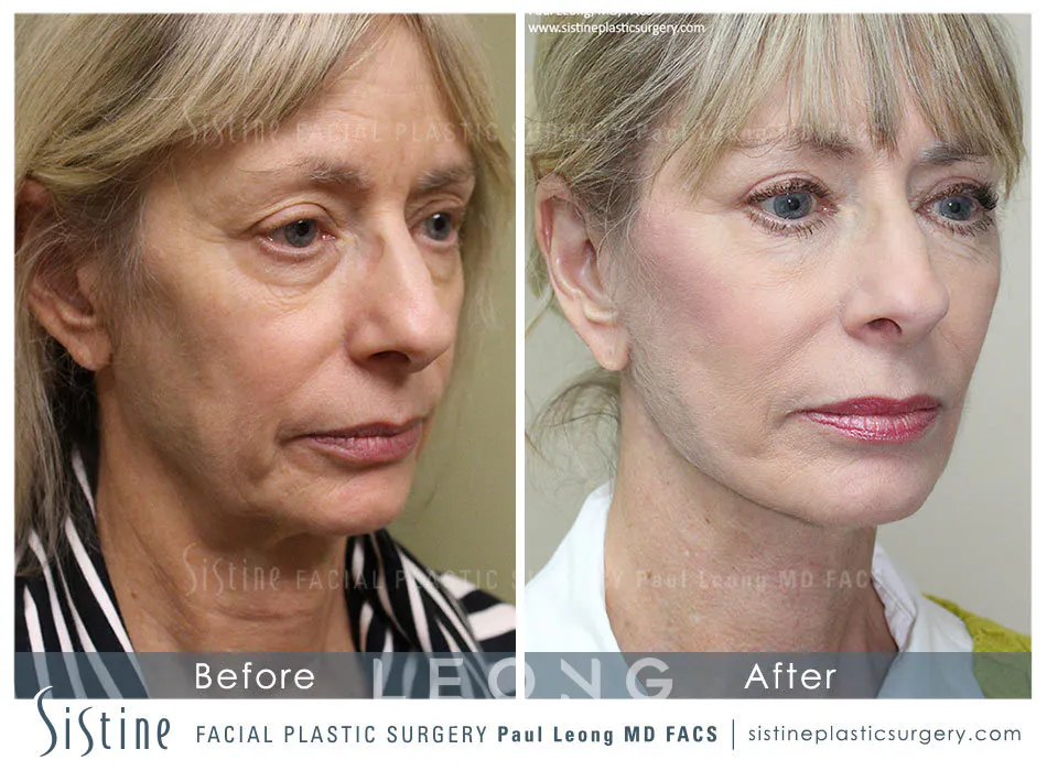 Blepharoplasty Before and After | Leong Facial Plastic Surgery
