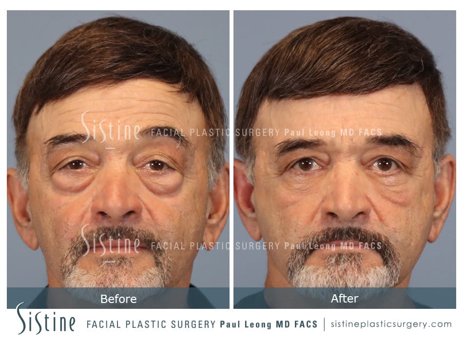 Blepharoplasty Before and After | Leong Facial Plastic Surgery