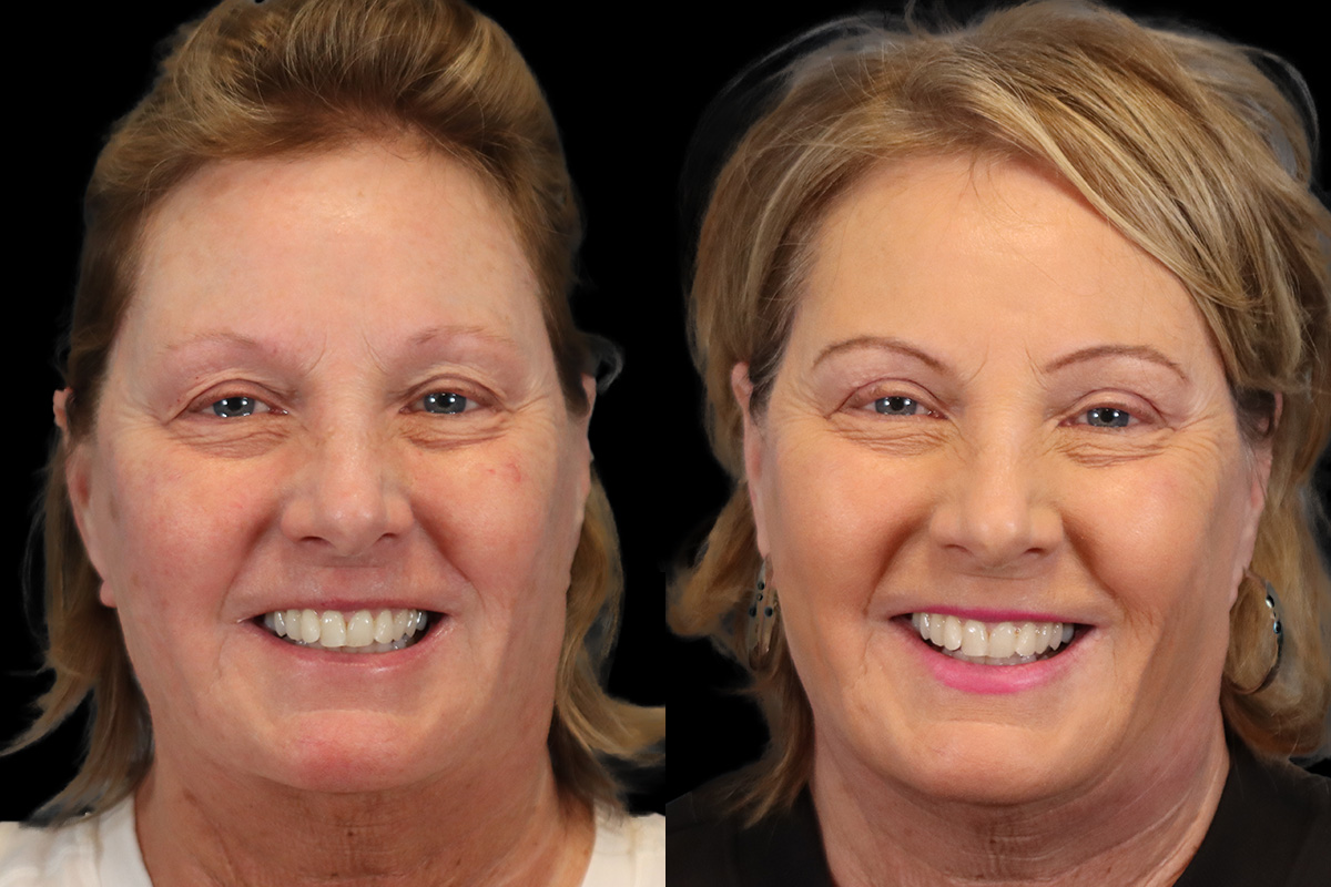 Blepharoplasty Before and After | Leong Facial Plastic Surgery