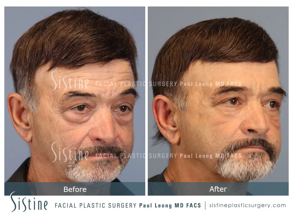 Blepharoplasty Before and After | Leong Facial Plastic Surgery