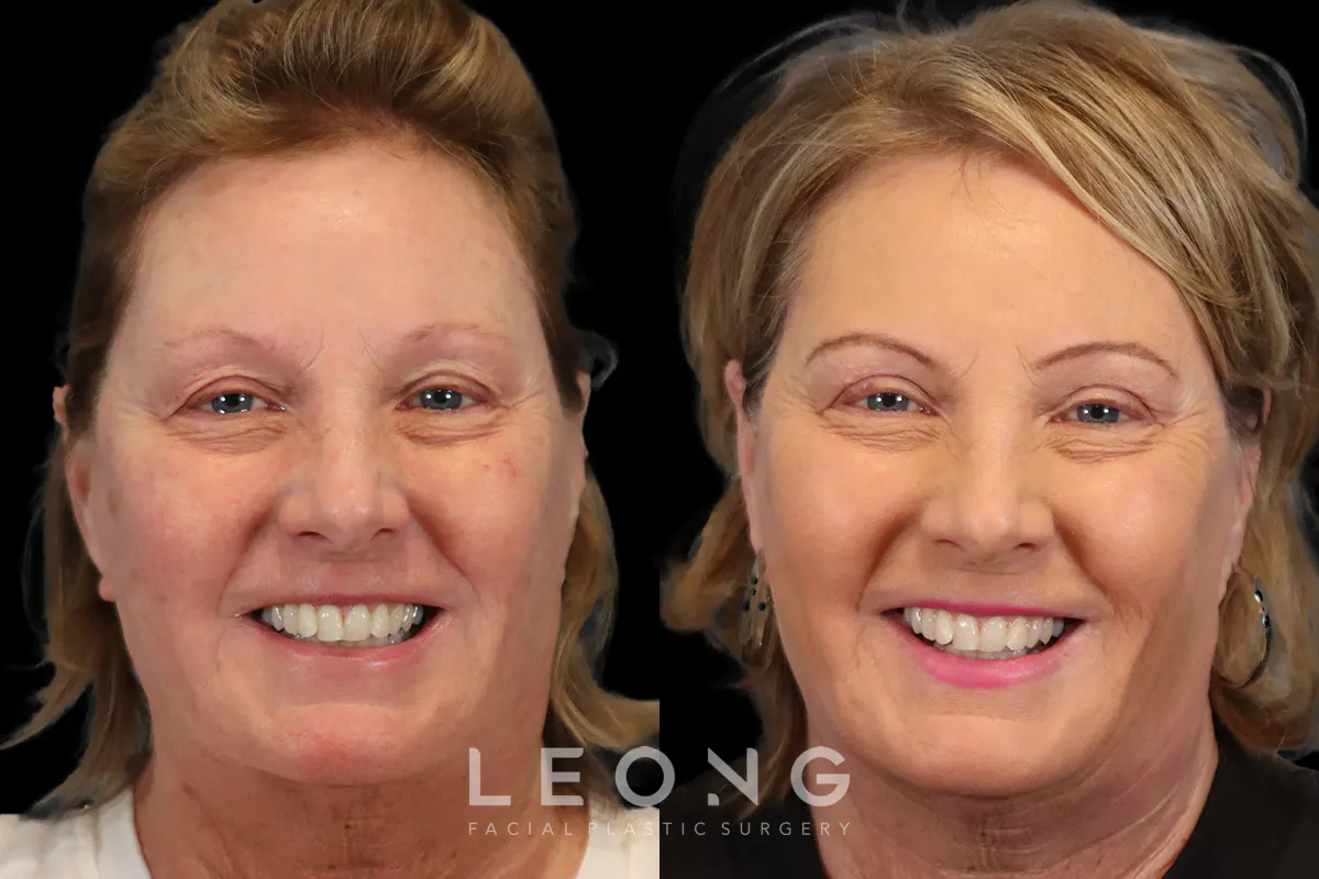 Blepharoplasty Before and After | Leong Facial Plastic Surgery