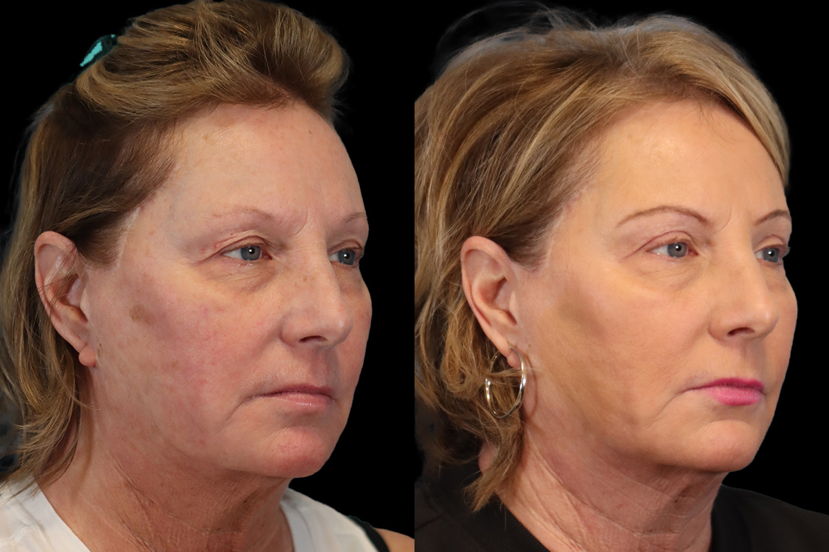 Blepharoplasty Before and After | Leong Facial Plastic Surgery