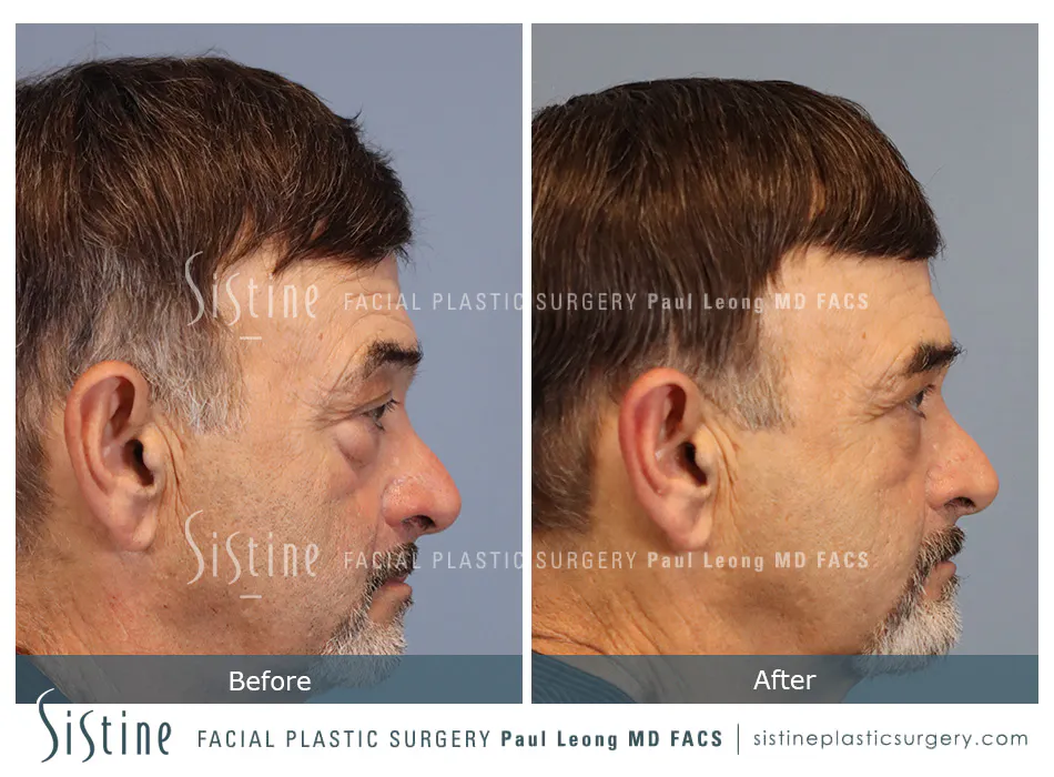 Blepharoplasty Before and After | Leong Facial Plastic Surgery