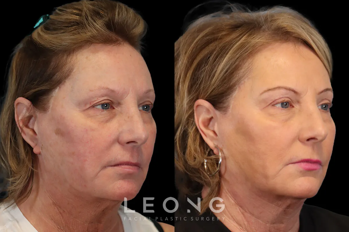 Blepharoplasty Before and After | Leong Facial Plastic Surgery