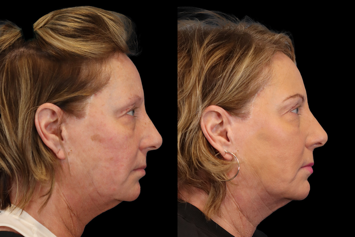 Blepharoplasty Before and After | Leong Facial Plastic Surgery