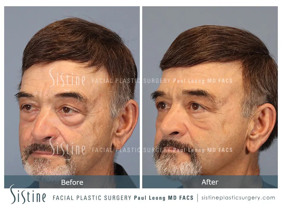 Blepharoplasty Before and After | Leong Facial Plastic Surgery