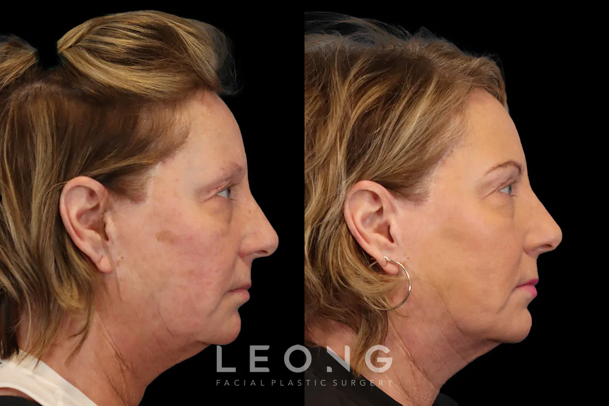 Blepharoplasty Before and After | Leong Facial Plastic Surgery