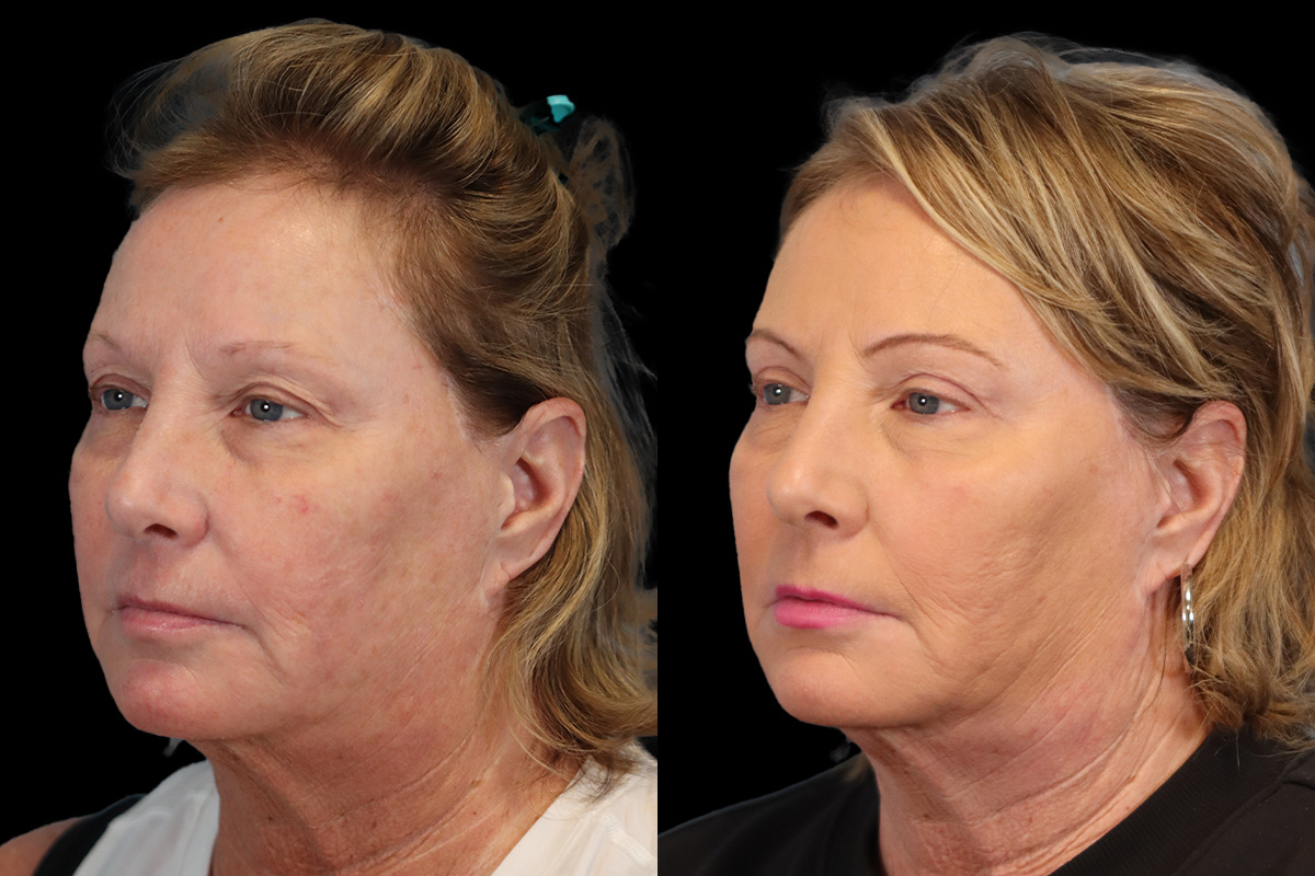 Blepharoplasty Before and After | Leong Facial Plastic Surgery