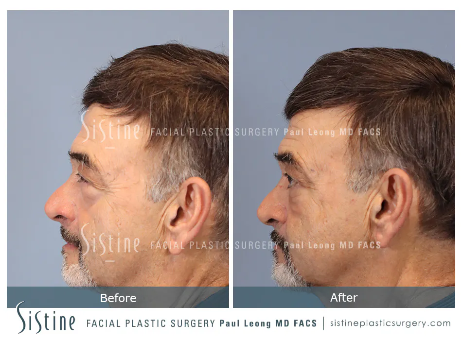 Blepharoplasty Before and After | Leong Facial Plastic Surgery