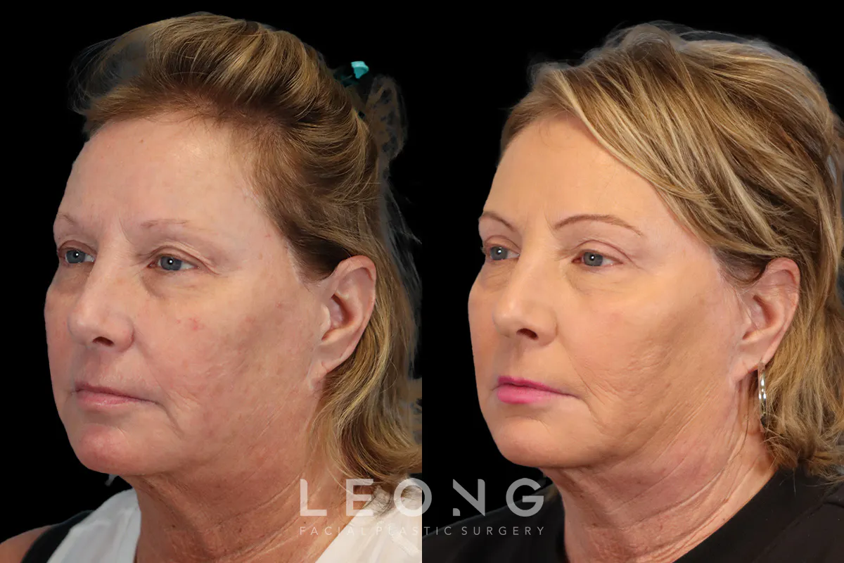 Blepharoplasty Before and After | Leong Facial Plastic Surgery