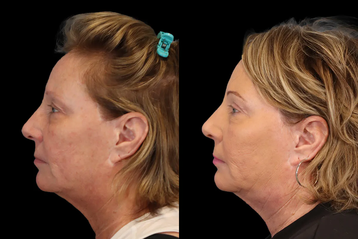 Blepharoplasty Before and After | Leong Facial Plastic Surgery