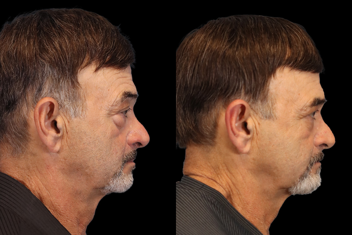 Blepharoplasty Before and After | Leong Facial Plastic Surgery