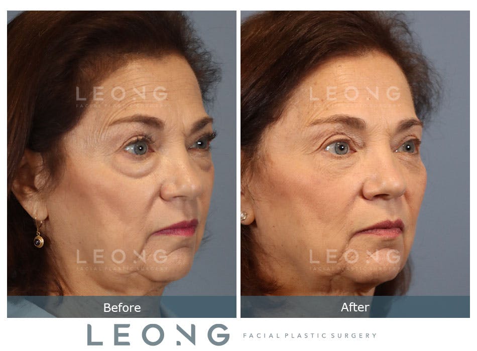 Blepharoplasty Before and After | Leong Facial Plastic Surgery
