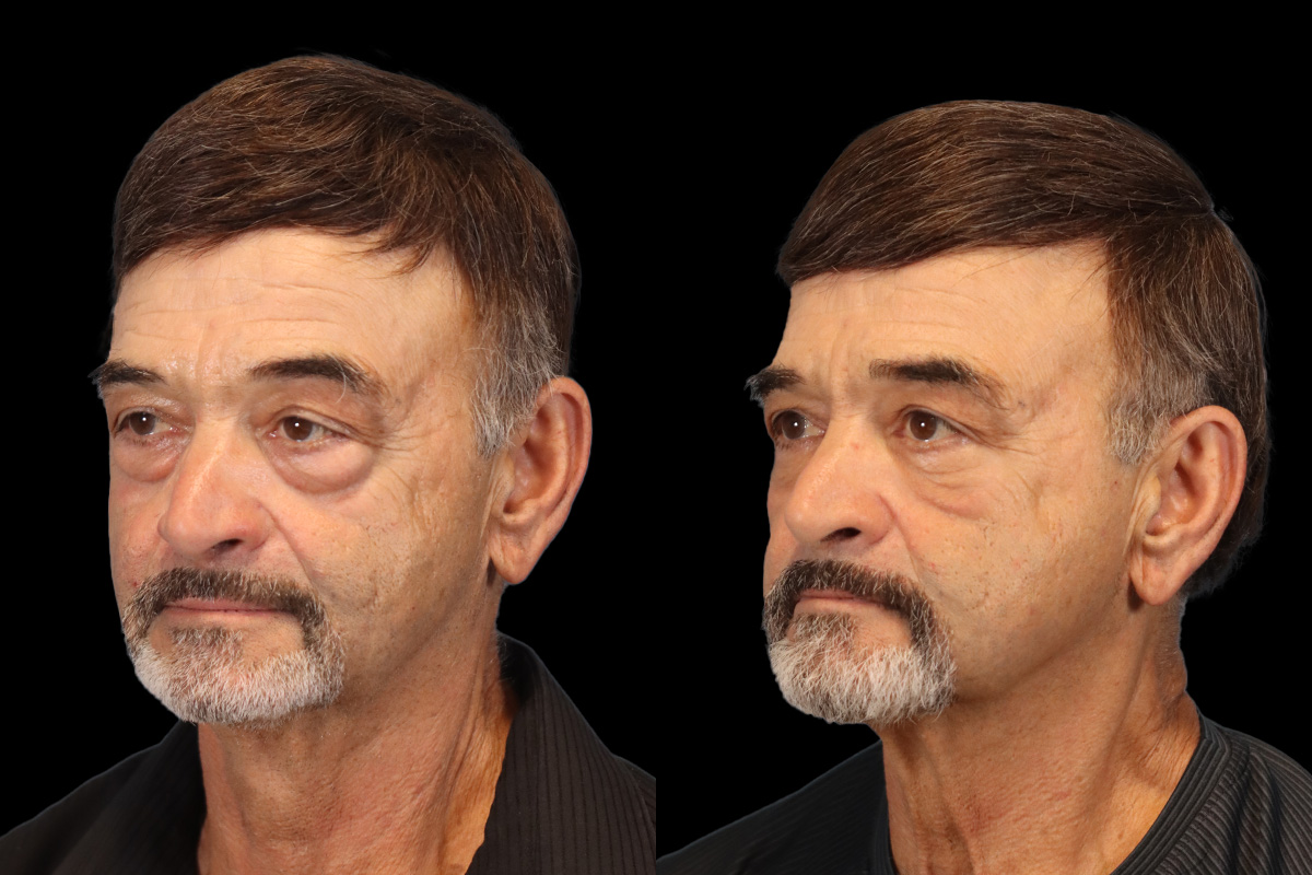 Blepharoplasty Before and After | Leong Facial Plastic Surgery