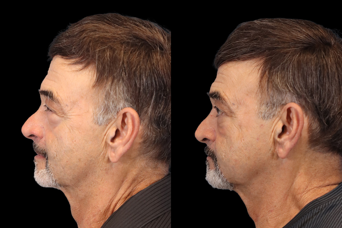 Blepharoplasty Before and After | Leong Facial Plastic Surgery