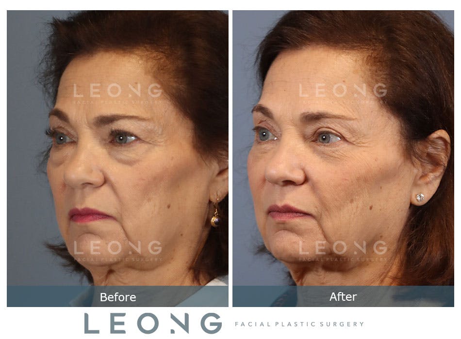 Blepharoplasty Before and After | Leong Facial Plastic Surgery