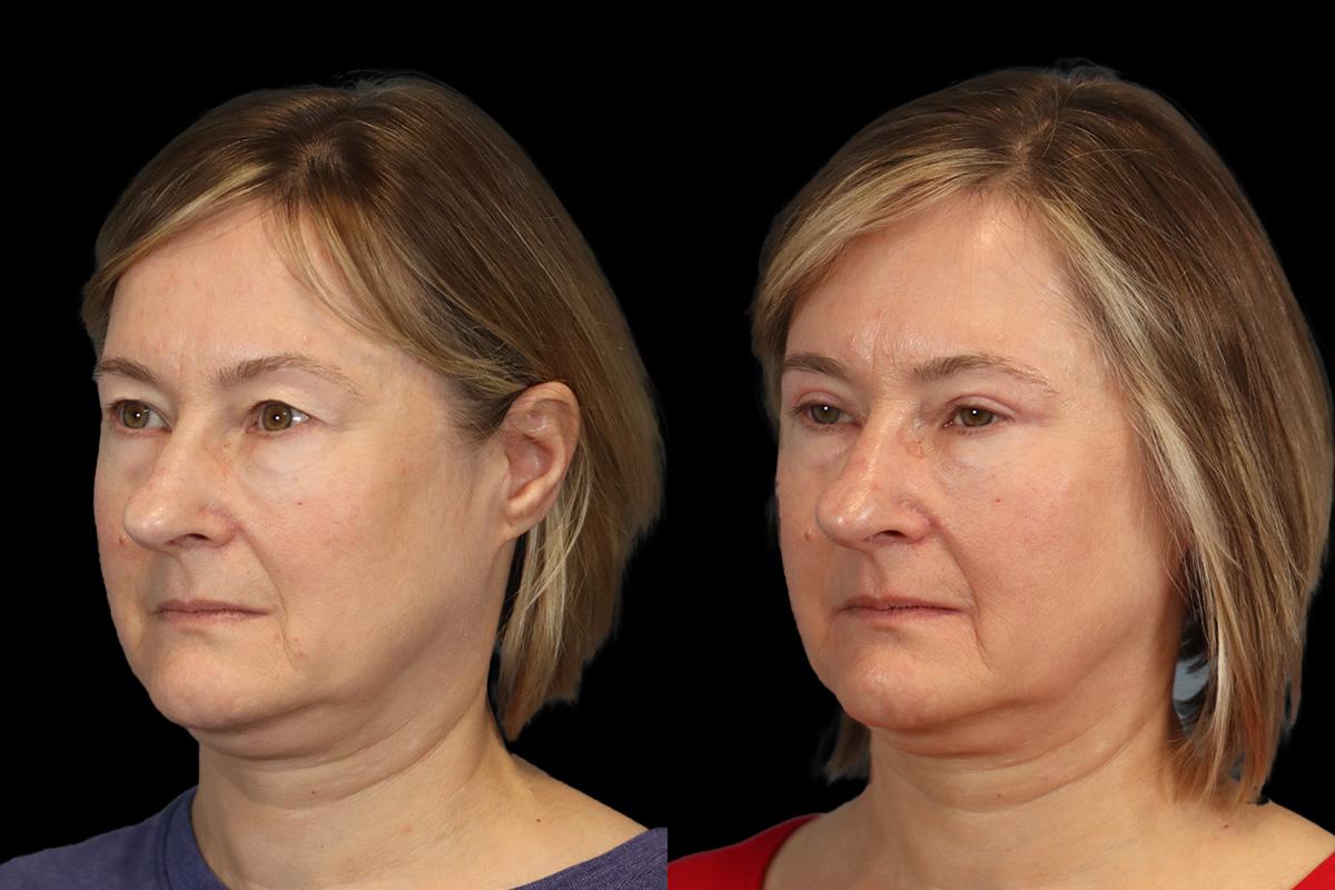 Blepharoplasty - Preoperative View | Sistine Facial Plastic Surgery