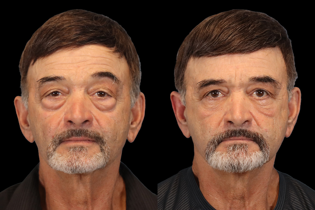 Blepharoplasty Before and After | Leong Facial Plastic Surgery
