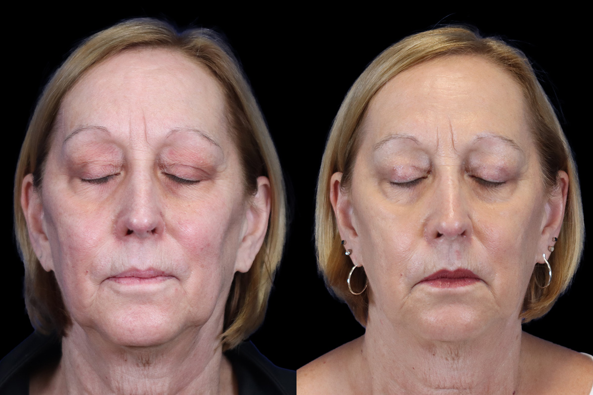 Blepharoplasty Before and After | Leong Facial Plastic Surgery