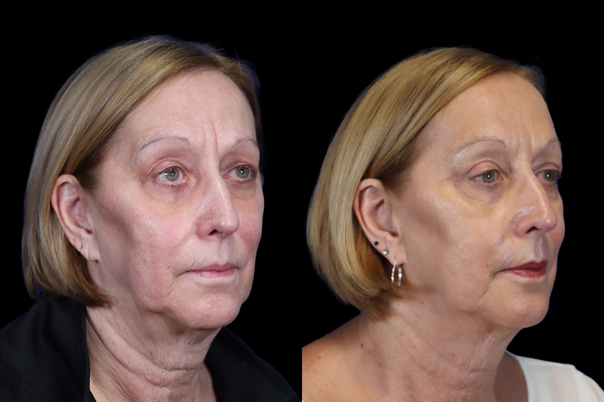 Blepharoplasty Before and After | Leong Facial Plastic Surgery