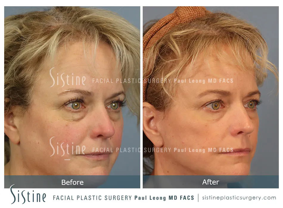 Blepharoplasty Before and After | Leong Facial Plastic Surgery