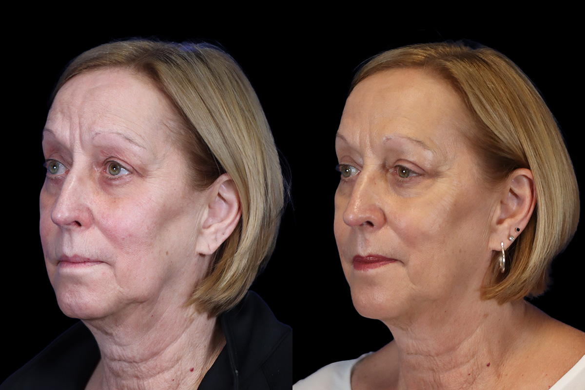 Blepharoplasty Before and After | Leong Facial Plastic Surgery