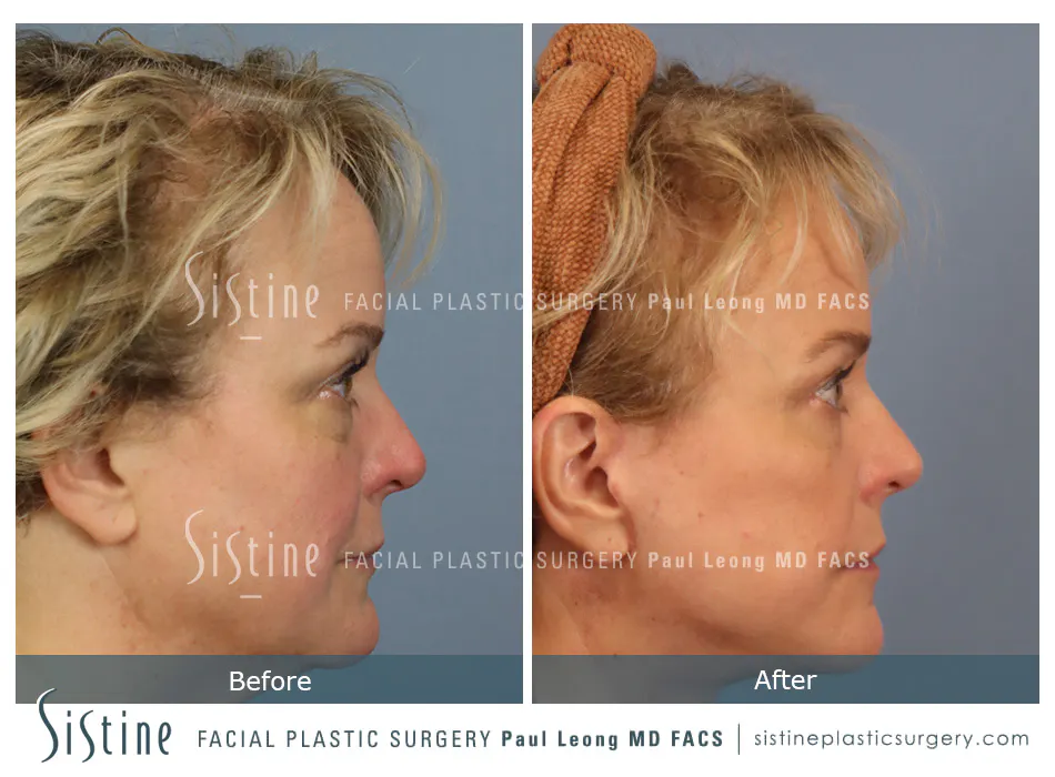 Blepharoplasty Before and After | Leong Facial Plastic Surgery