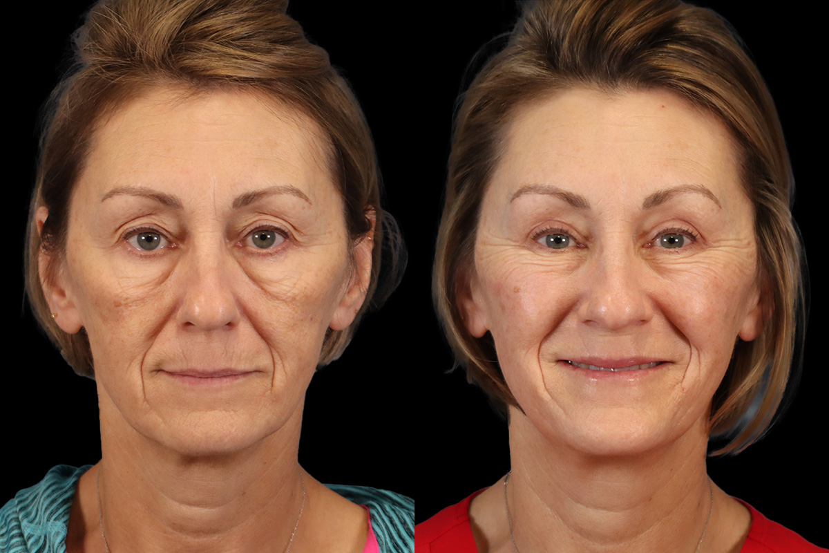 Blepharoplasty Before and After | Leong Facial Plastic Surgery