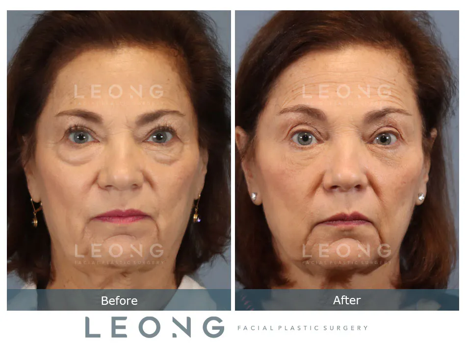 Blepharoplasty Before and After | Leong Facial Plastic Surgery