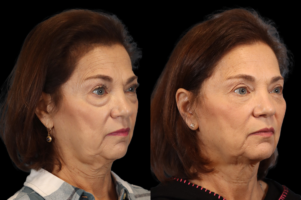 Blepharoplasty Before and After | Leong Facial Plastic Surgery
