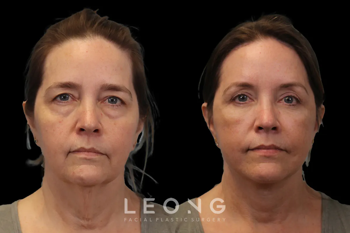 Blepharoplasty Before and After | Leong Facial Plastic Surgery