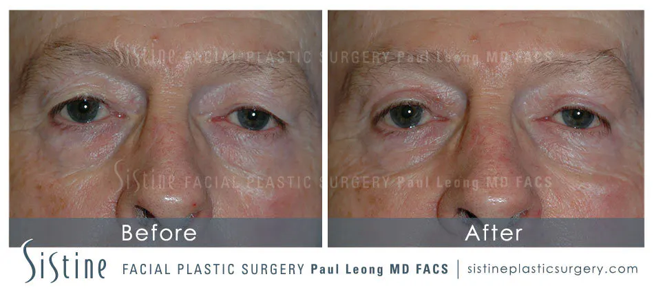 Blepharoplasty Before and After | Leong Facial Plastic Surgery