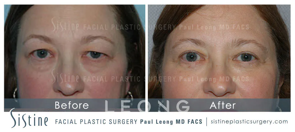 Blepharoplasty Before and After | Leong Facial Plastic Surgery