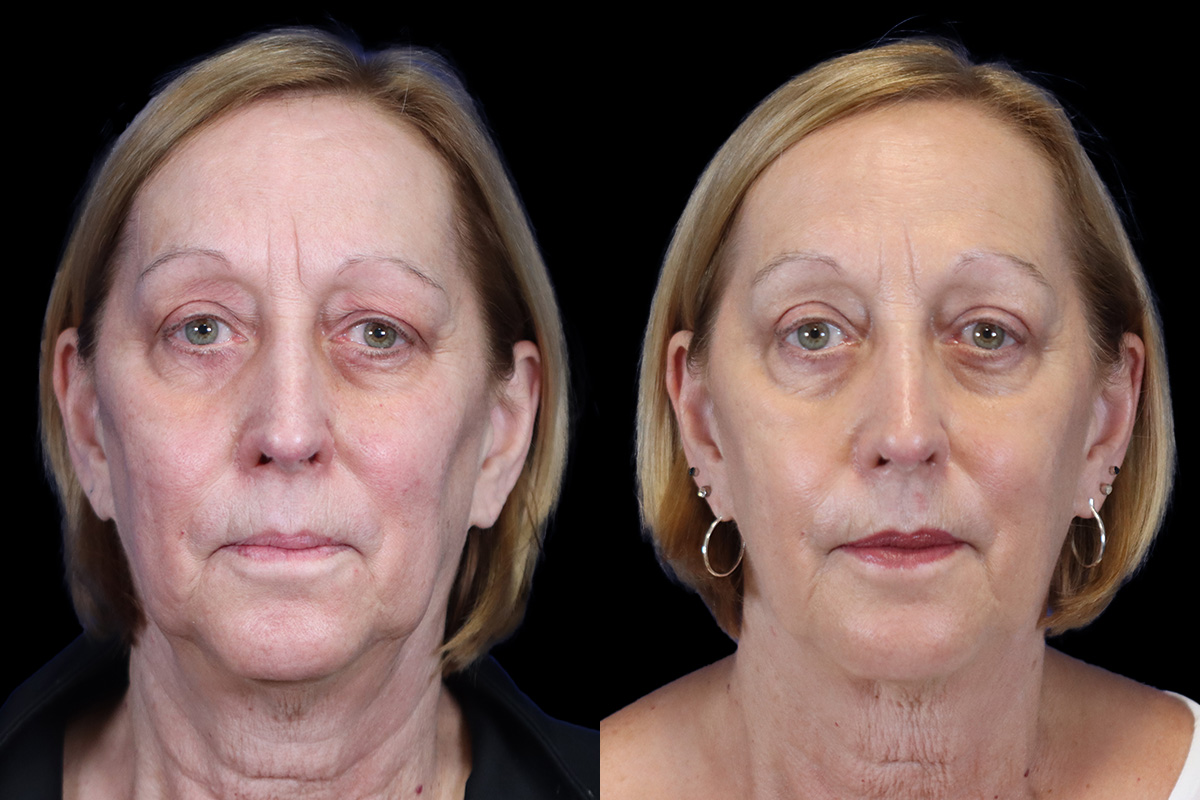 Pittsburgh Face and Neck Lift - Frontal Preoperative View | Sistine Facial Plastic Surgery 