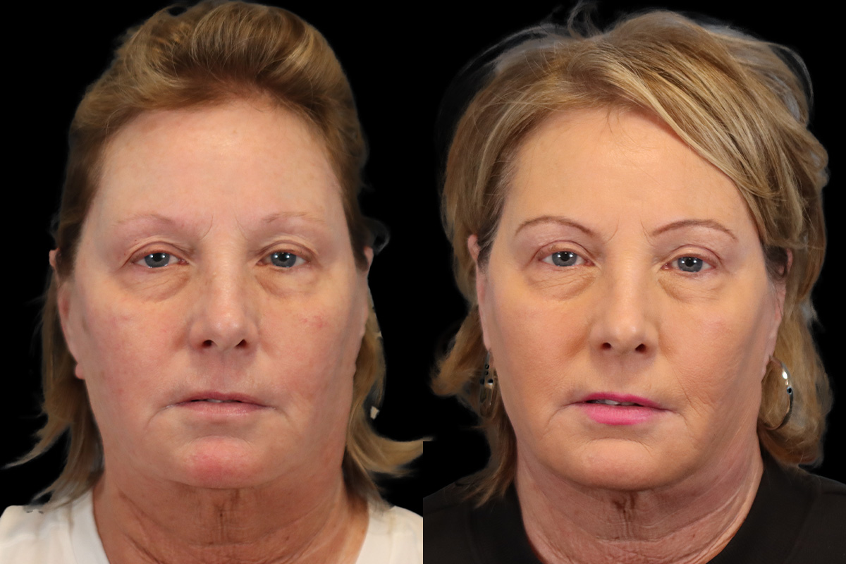 Blepharoplasty Before and After | Leong Facial Plastic Surgery