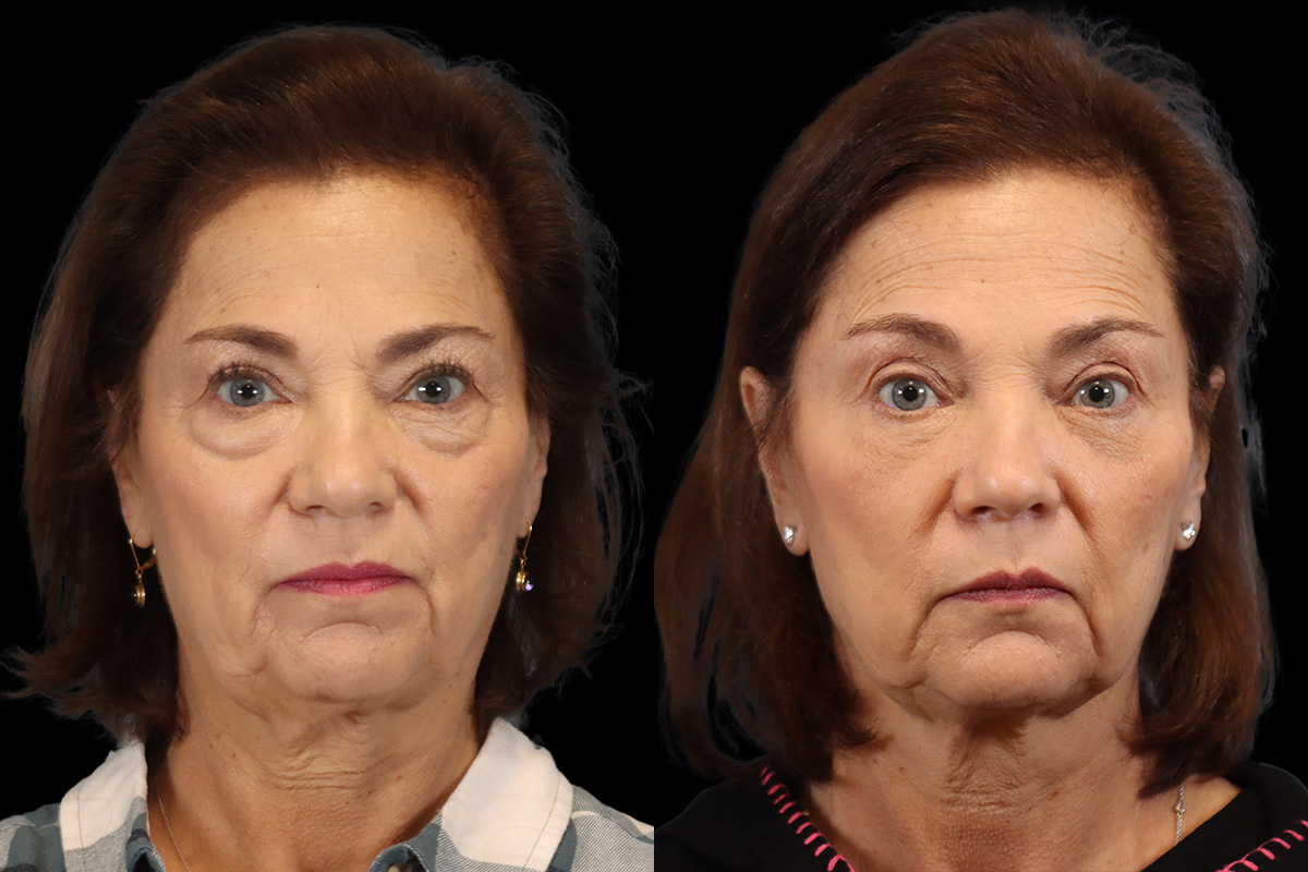 Blepharoplasty - Preoperative View | Sistine Facial Plastic Surgery
