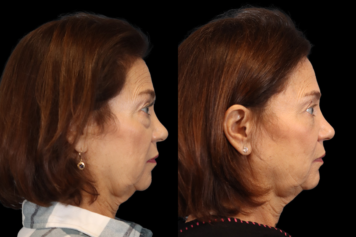 Blepharoplasty - Preoperative View | Sistine Facial Plastic Surgery