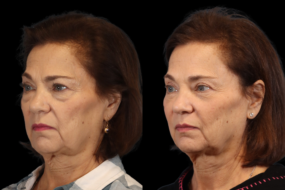 Blepharoplasty - Preoperative View | Sistine Facial Plastic Surgery