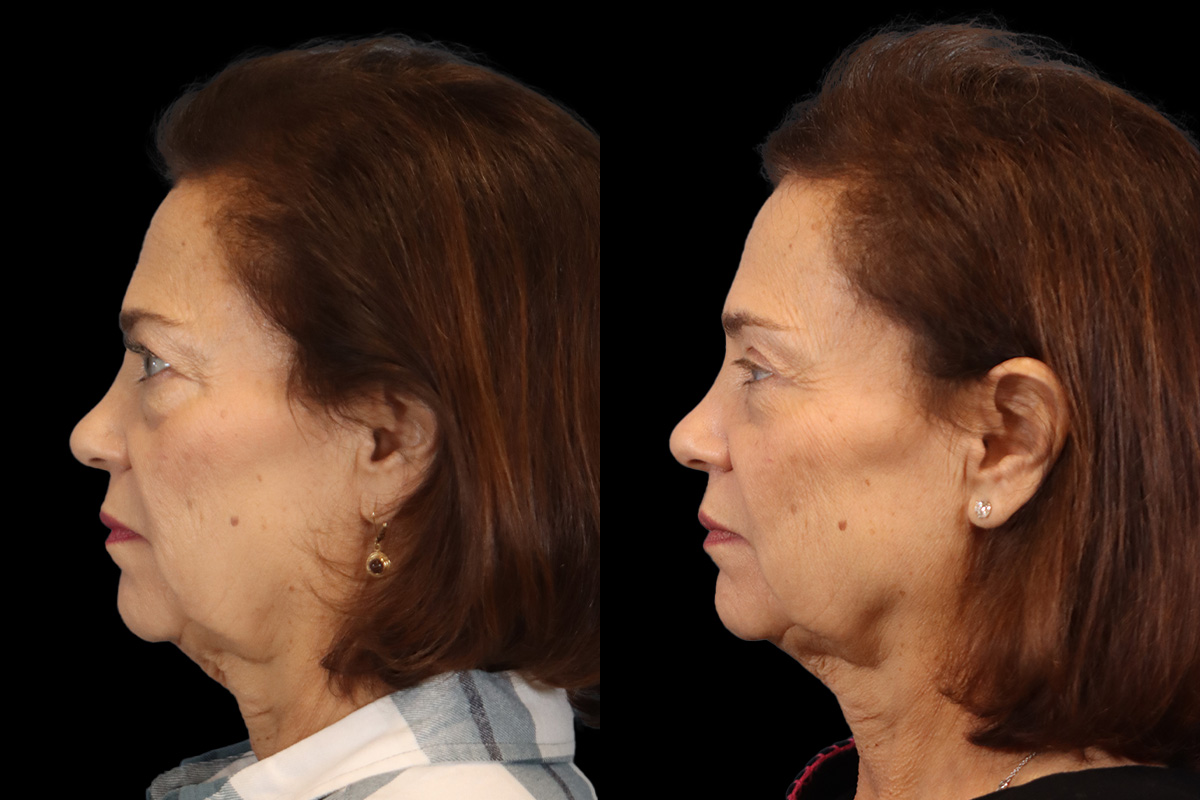 Blepharoplasty - Preoperative View | Sistine Facial Plastic Surgery