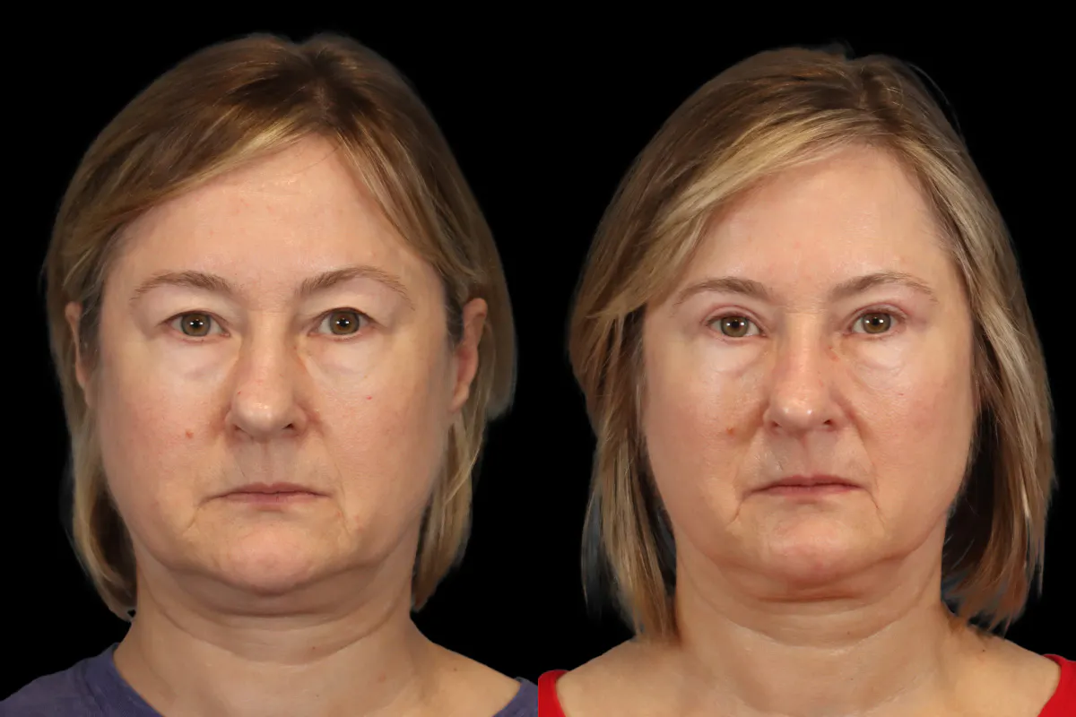 Blepharoplasty Before and After | Leong Facial Plastic Surgery