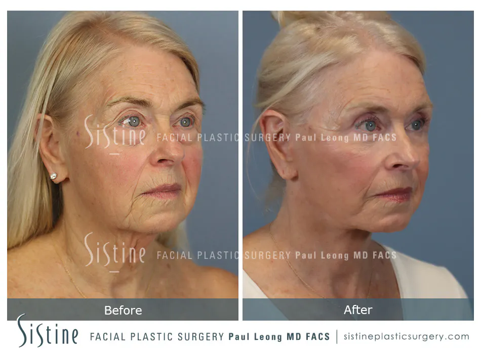 Blepharoplasty Before and After | Leong Facial Plastic Surgery