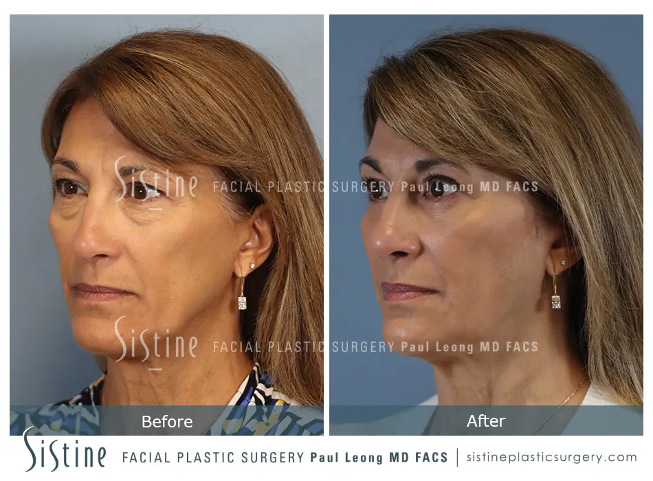 Blepharoplasty Before and After | Leong Facial Plastic Surgery