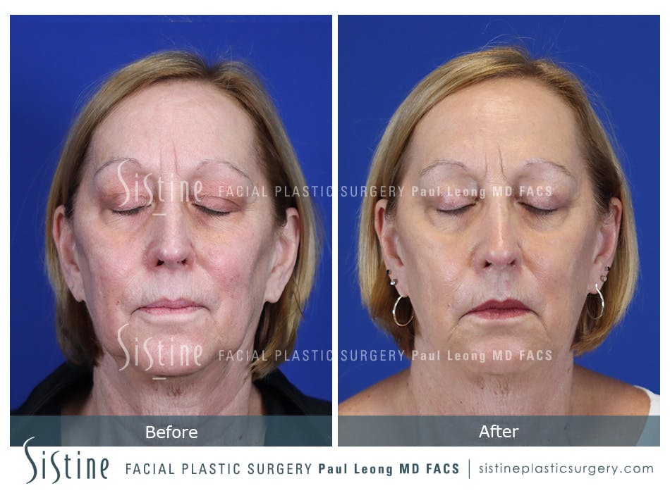 Blepharoplasty Before and After | Leong Facial Plastic Surgery