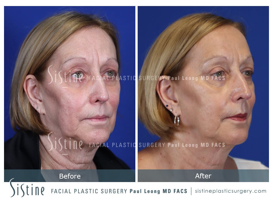 Blepharoplasty Before and After | Leong Facial Plastic Surgery
