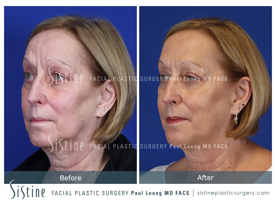 Blepharoplasty Before and After | Leong Facial Plastic Surgery