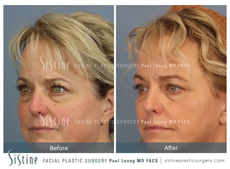 Blepharoplasty Before and After | Leong Facial Plastic Surgery