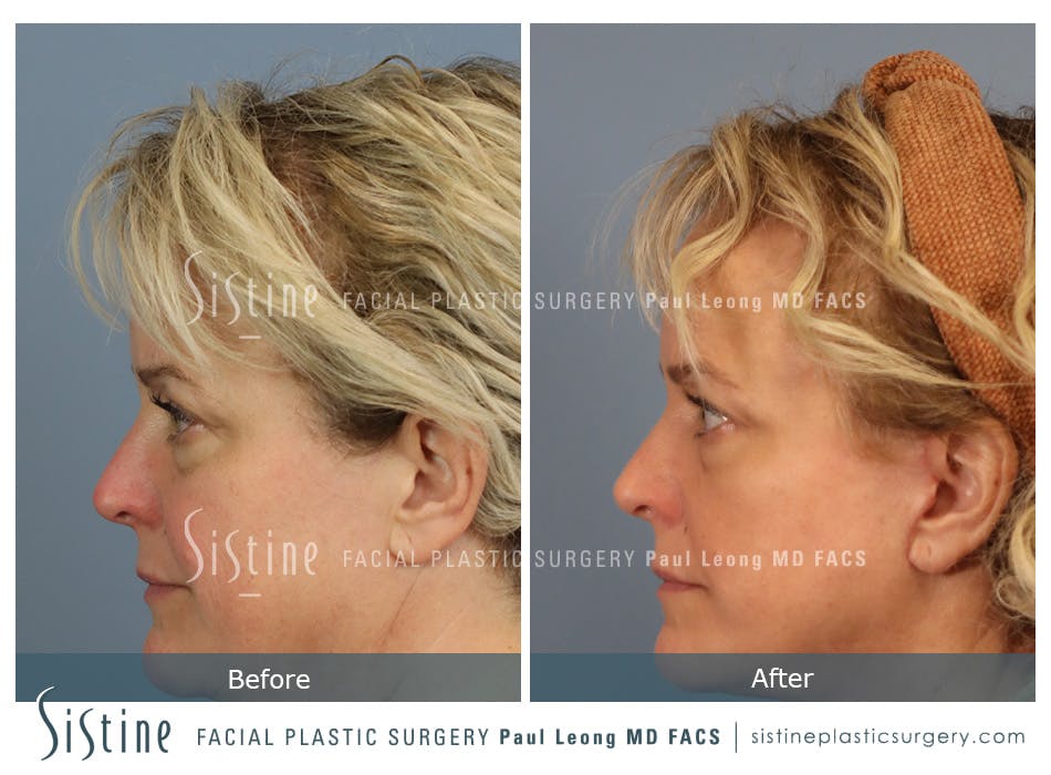 Blepharoplasty Before and After | Leong Facial Plastic Surgery