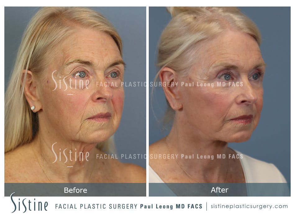 Blepharoplasty Before and After | Leong Facial Plastic Surgery