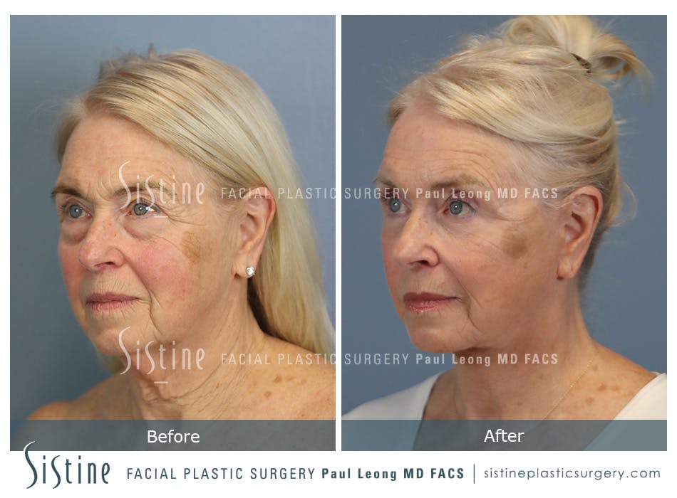Blepharoplasty Before and After | Leong Facial Plastic Surgery